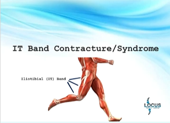 ILIOTIBIAL BAND CONTRACTURE